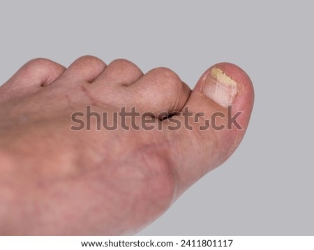 Onycholysis , A close-up of a foot with a fungus , Bare foot with onycholysis on a toenail after damaging with tight shoes, detachment of the nail from the nail bed.