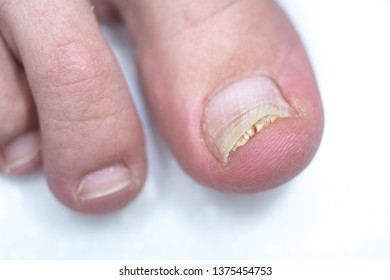 Onycholysis isolated on white background. Mechanical damage to the nail plate. Damage to the nail after applying shellac or gel-varnish (Gel-lacquer). - Shutterstock ID 1375454753