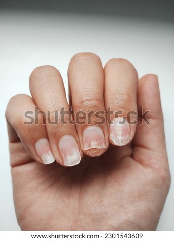 Onycholysis on the fingernails. Nails after removing the hybrid manicure