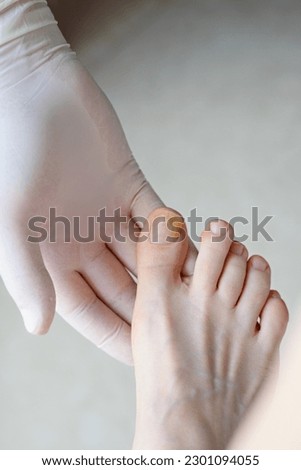 Onychomycosis. Feet with fungus on nails are examined by podiatrist in gloves