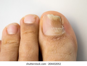 Onychomycosis With Fungal Nail Infection