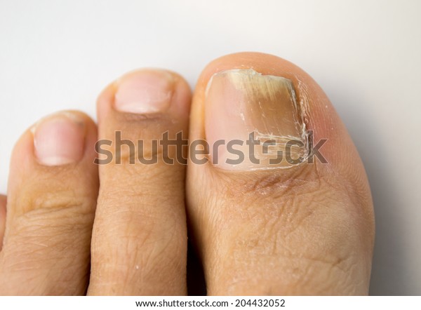 onychomycosis with fungal nail\
infection