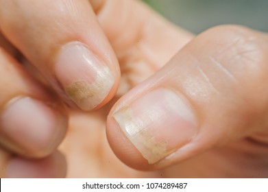 Nail Fungus Hd Stock Images Shutterstock