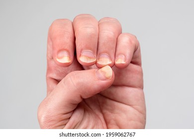 Onychomycosis or fungal nail infection on damaged nails after gel polish, onychosis. Longitudinal ridging nails with psoriasis. Nail diseases, health and beauty problem - Shutterstock ID 1959062767