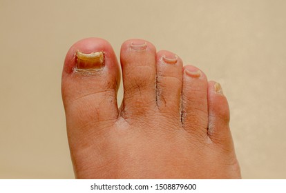 Onychomycosis Nail Fungal Foot Care Antifungal
