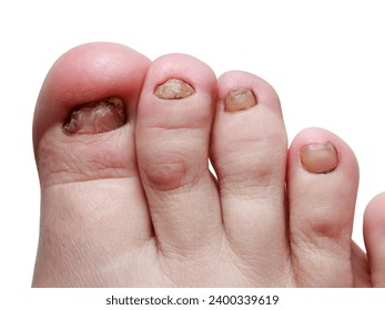 Onicomicosis, onicolisis, paronicemia. Enfermedades de uñas, infección por hongos de uñas. uña humana amarilla herida.