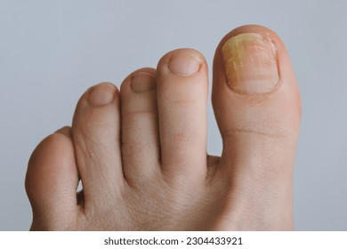 Onychomycosis. Unaesthetic appearance of toenails affected by fungal infection