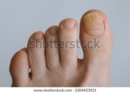 Onychomycosis. Unaesthetic appearance of toenails affected by fungal infection