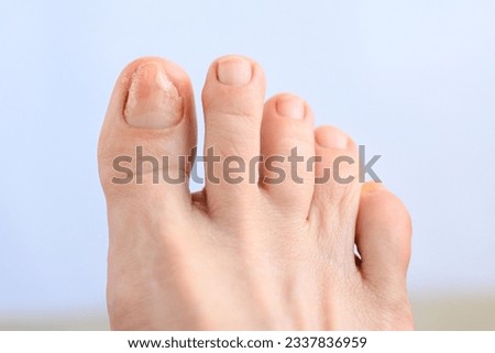 Onychomycosis. Unaesthetic appearance of toenails affected by fungal infection