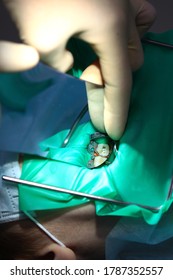 An Open Baby Tooth. Operation To Remove Multiple Deep Caries. The Concept Of Health. Copy Space. Vertical Photo.