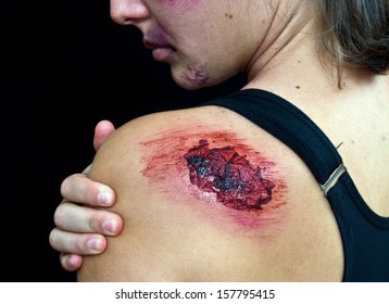 Open Bloody Wound On Woman Shoulder