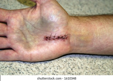 Open Carpal Tunnel Release Surgery Stitches