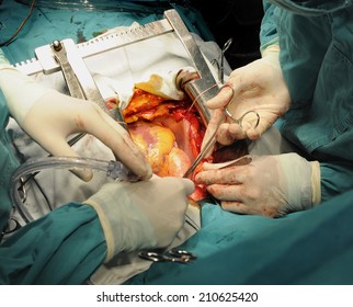 Open Heart Surgery