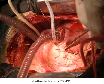 Open Heart Surgery