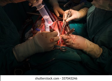 Open Heart Surgery