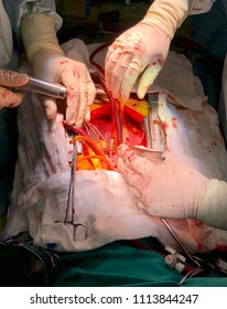Open Heart Surgery With Cardiopulmonary Bypass In Operating Room