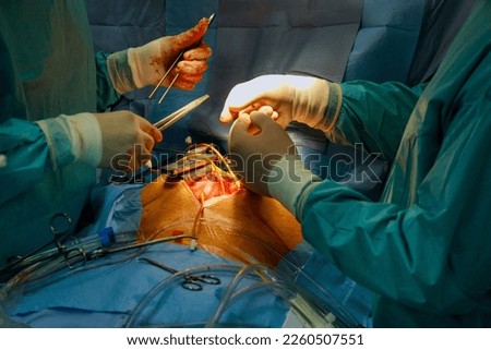 Open heart surgery due to malfunction of the heart valve, valve replacement is performed in the hospital operation room