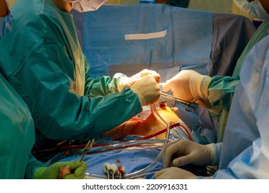 An open heart surgery is performed in operating room the case of a malfunctioning heart valve, which requires valve replacement.