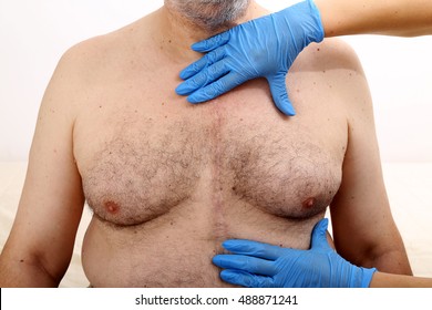 Open Heart Surgery Scar 