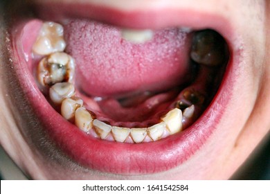 open mouth with broken, diseased teeth affected by caries and periodontitis. Steel pin in  gum for  installation of  dental crown. Smoker's teeth coated with nicotine plaque.