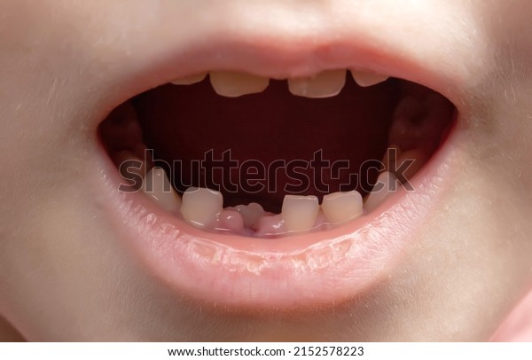 The open mouth of a child without one tooth. Loss\
of milk teeth