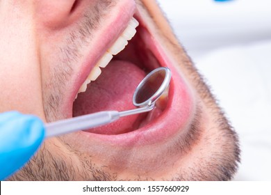 Open Mouth With Dentist's Mirror