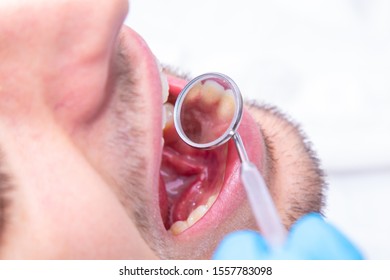 Open Mouth With Dentist's Mirror