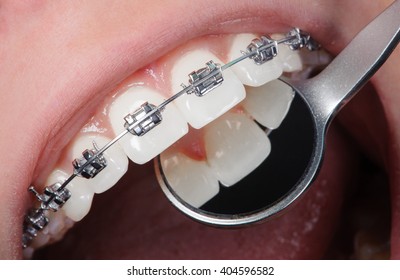 Open mouth showing stainless steel braces. Healthy teeth. Dental care Concept. Orthodontic Treatment.