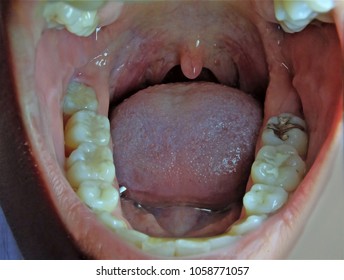 Wide Open Mouth Revealing Teeth Tongue Palate And Uvula