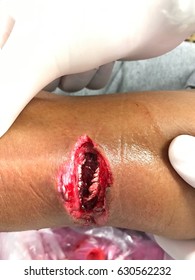 Open Wound At Leg.