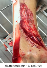 Open Wound Seen To Bone And Tendon At Hand