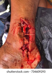 Open Wound And Tendon Injury