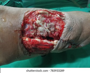 Open Wound And Tendon Injury