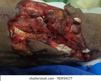 Open Wound And  Tendon Injury