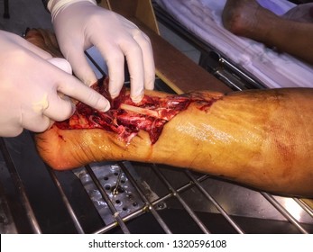 Open Wound And Tendon Injury Of Leg 