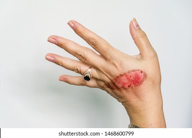 An Open Wound Of Woman's Hand With Thermal Burn Of Second Degree Injury Of Skin After Boiling Water On White Background. Home Accident, Boiling Tea Sloppy Behavior. On Finger Is Ring With Blue Stone