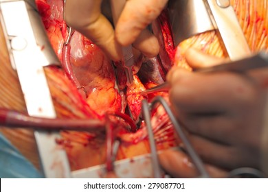 Open-heart Surgery Coronary Artery Bypass Grafting Macro 