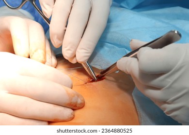 Operation on the stomach. Medical procedure for treating a patient with a surgical intervention in the operating room - Shutterstock ID 2364880525
