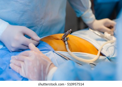 Operation Using Endoscope Gynecology Stock Photo 510957514 | Shutterstock