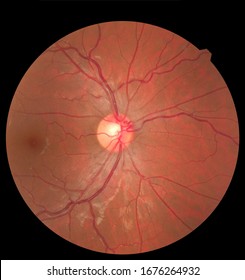 Ophthalmic Image Detailing The Retina And Optic Nerve Inside A Healthy Human Eye. Health Protection Concept