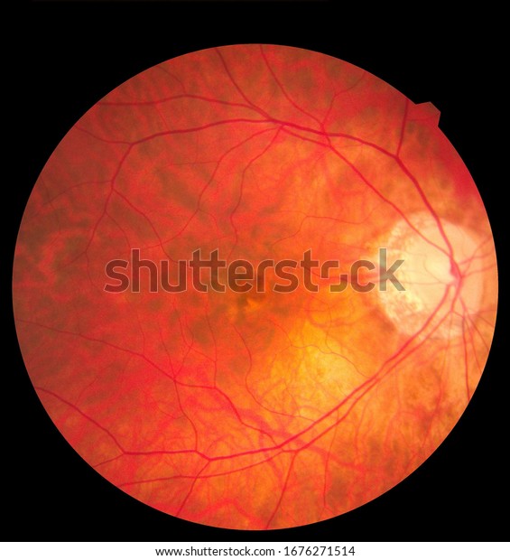Ophthalmic image detailing the\
retina and optic nerve inside a healthy human eye. Medicine\
concept