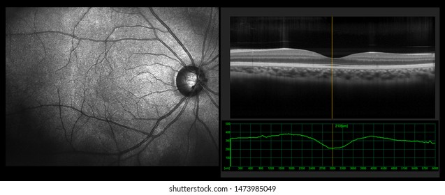 Ophthalmic test - OCT optical coherence tomography measurement. SLO Scan view of the macula in retina with vessels