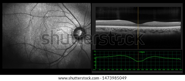 Ophthalmic test -\
OCT optical coherence tomography measurement. SLO Scan view of the\
macula in retina with\
vessels