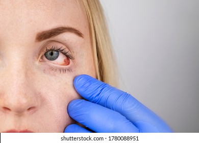 An Ophthalmologist Examines A Woman Who Complains Of A Burning Sensation And Pain In Her Eyes. Eye Fatigue From A Computer Screen Or Telephone (sand Sensation On The Cornea)