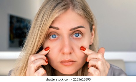 Ophthalmology, Vision Problems. Portrait Of 30 Year Old Blue Eyed Woman, Pulling Back Skin Under Her Eyes, Looks At Camera With Frustrated Look. Problems Of Aging And Appearance. Optometrist, Surgery