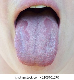 Oral Candidiasis Or  Oral Trush ( Candida Albicans), Yeast Infection On The Human Tongue Close Up, Common Side Effect When Using Antibiotics Or Another Medicaments