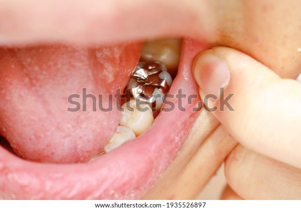 Oral cavity of the Japanese. In Japan,\
silver coverings are used to treat\
teeth.