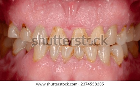 The oral cavity of patient who was bruxism, his or her teeth were short clinical crown, enamel loss and exposed to dentin of teeth, the cavity on occlusal surface was cup-liked shape.