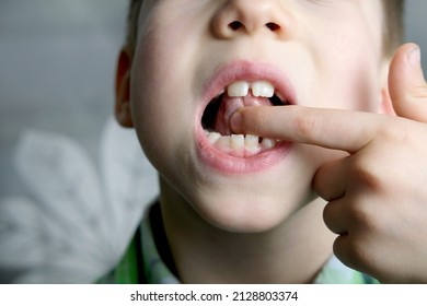 oral cavity of small patient, length of frenum of the tongue, boy, kid performs articulation exercises for mouth, concept of speech disorders, correction