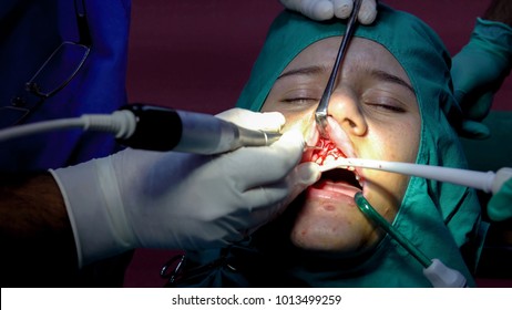 Oral Dental Surgery Operation, Tooth Gum Apicoectomy Cyst Removal